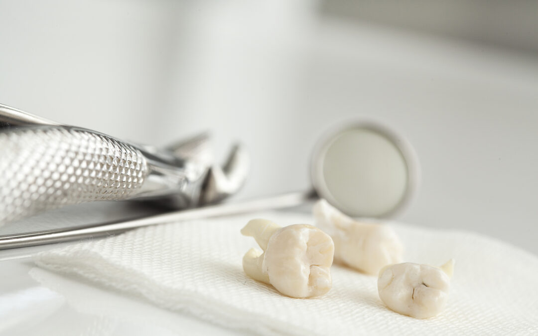 Wisdom Tooth Extraction: Risks & Complications