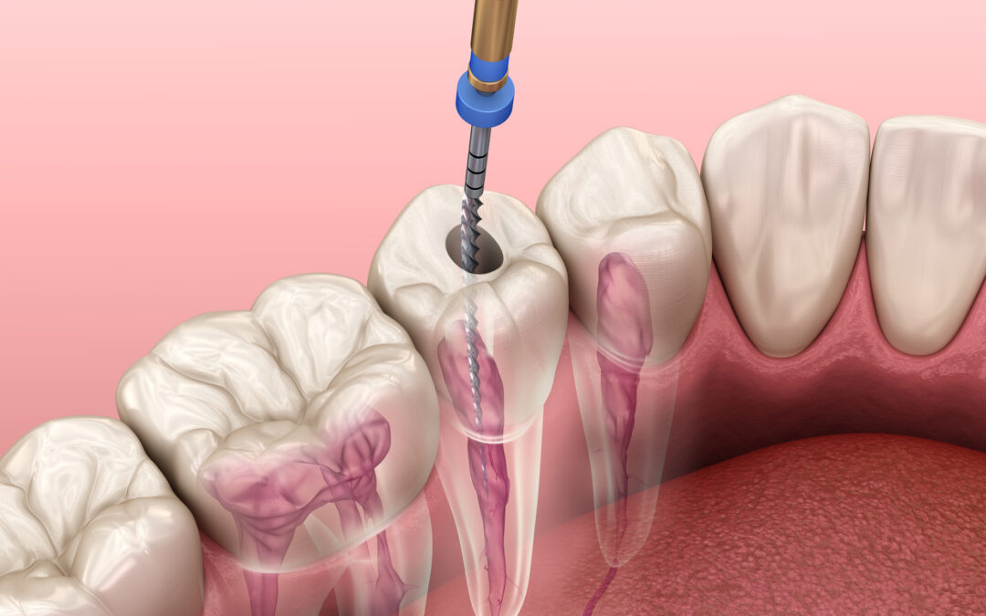 Root Canal Therapy: Single Vs Multiple Treatments