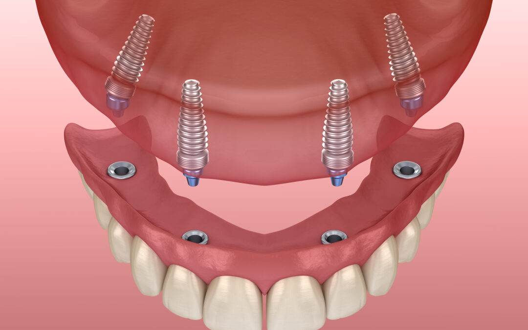 all on 4 plus dental implants