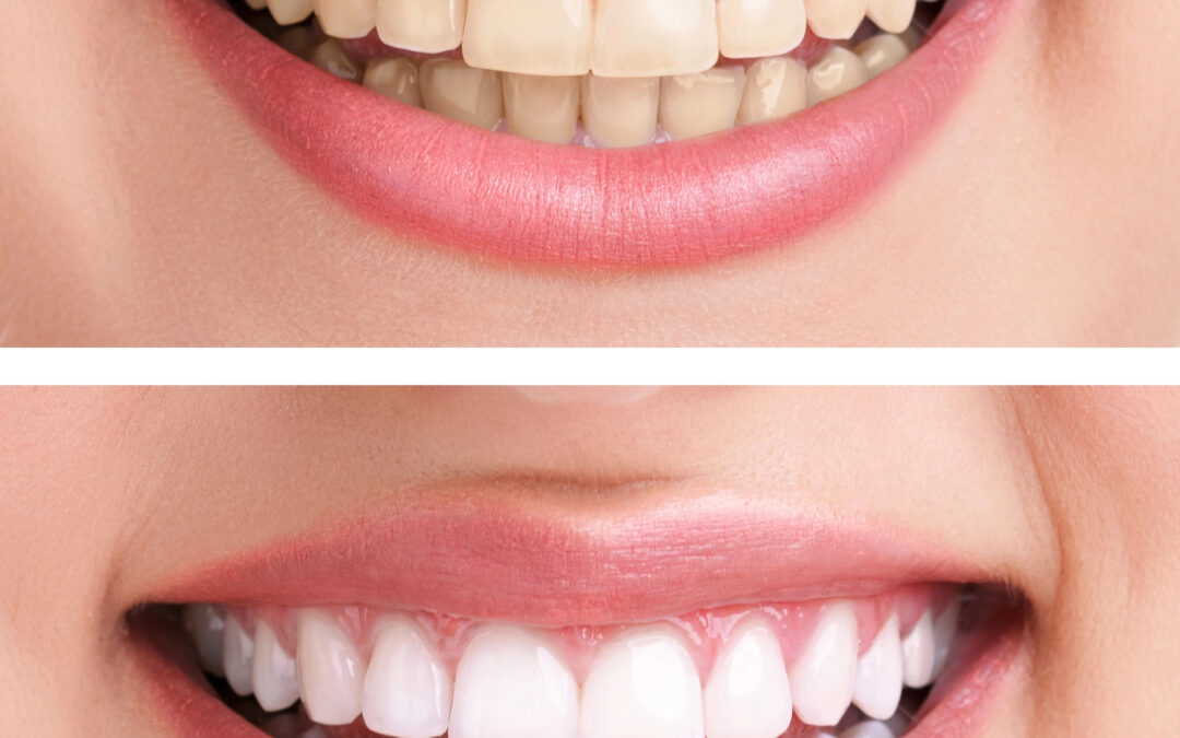 Exploring the Rising Trend of Teeth Whitening