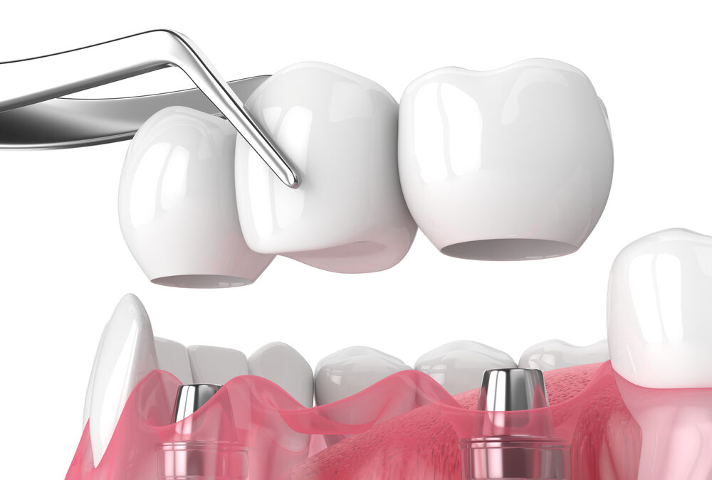 How to Save Money on Dental Crowns Without Sacrificing Quality